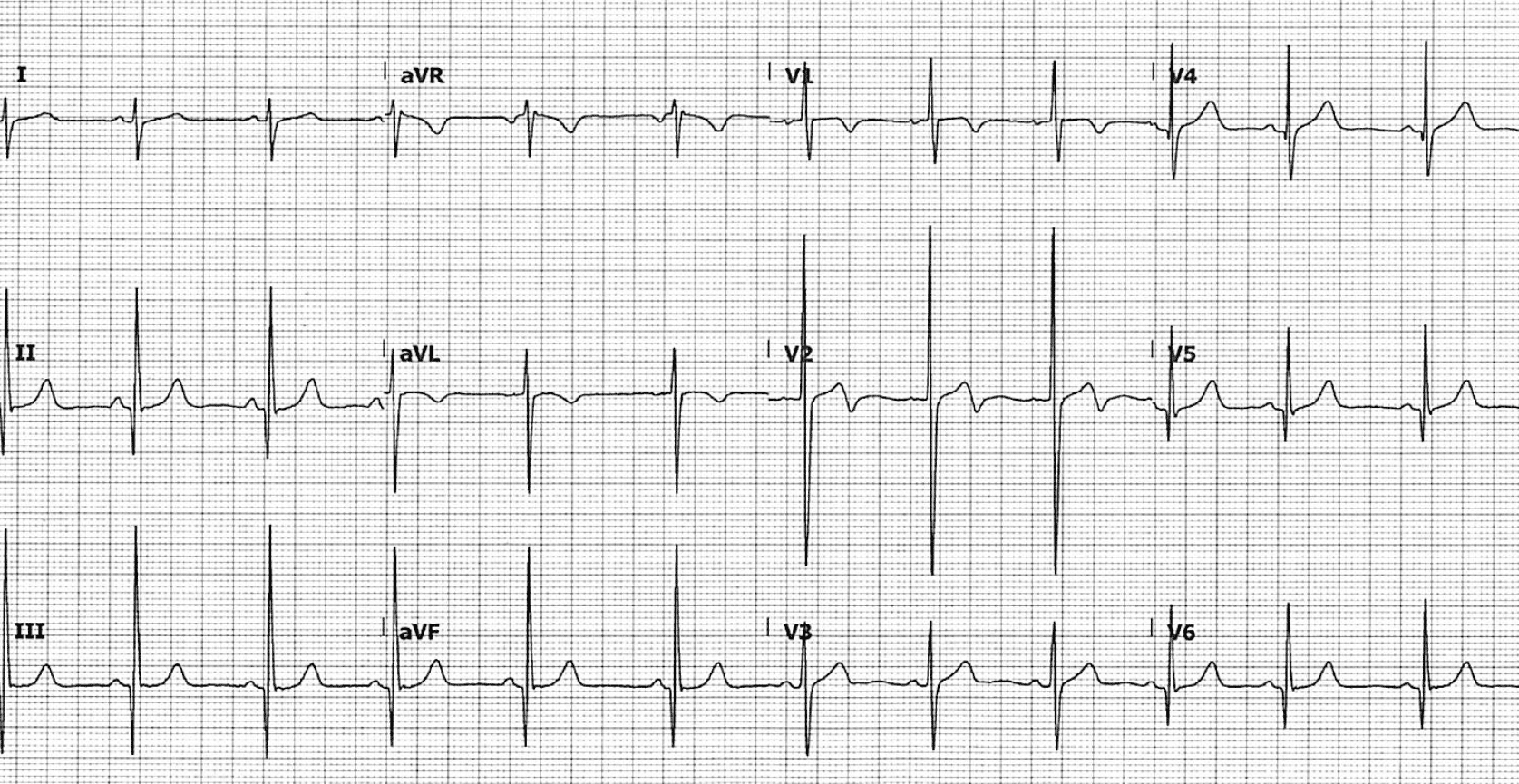 <p>A 19-year-old man collapses during basketball practice after experiencing sudden lightheadedness and chest pain. His father died suddenly at age 35. Vital signs are stable. Cardiac examination reveals a harsh systolic murmur best heard along the left sternal border that increases with Valsalva maneuver and decreases with squatting. ECG shows left ventricular hypertrophy. What is the most likely diagnosis?</p>