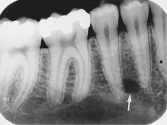 <p>Radiolucent round/oval area near mandibular premolars</p>