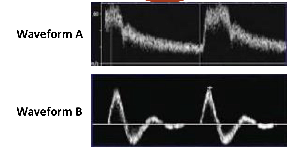 <p>Which spectral doppler waveform most likely represents high resistance vascular bed?</p>