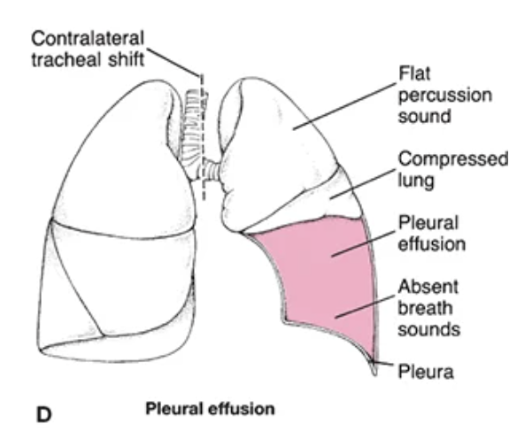 <p>excess fluid accumulates in pleural space, compressing lung</p><ul><li><p>lung effusion may cause tracheal shift away from the affected side</p></li></ul><p></p>