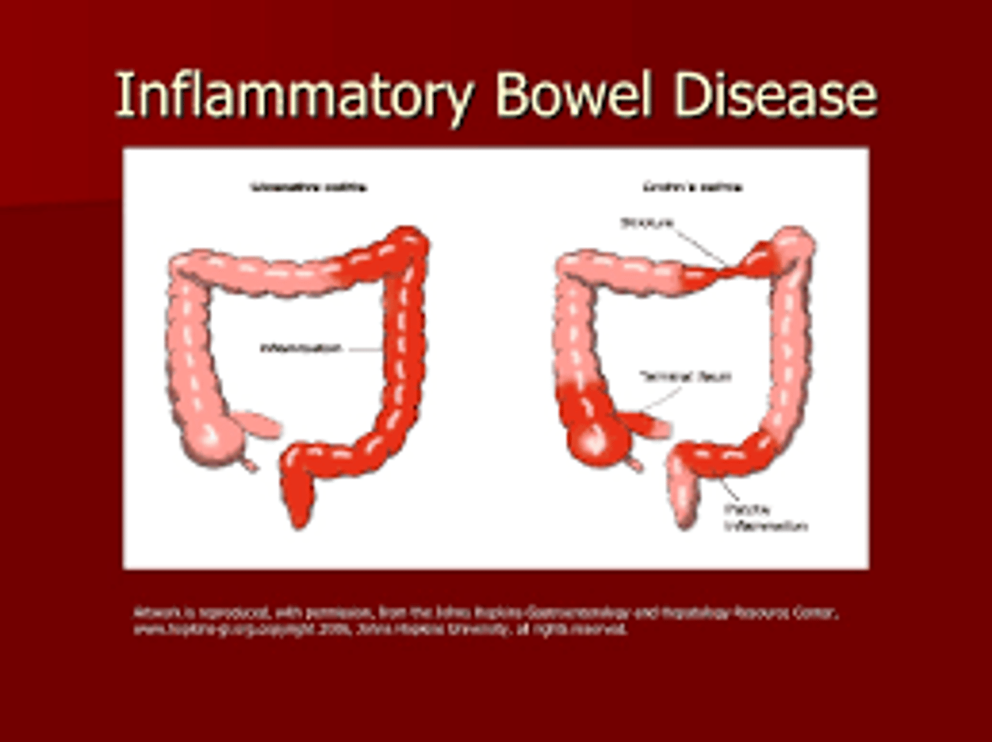 <p>IBD</p>