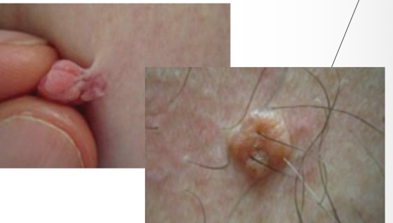 <p>Amelanotic Melanoma: </p><ul><li><p>MC in very fair-skin</p></li><li><p>evolution or rapid change #1 FEATURE</p></li></ul><p>MIMIC: Skin tags/Intradermal Nevi</p><ul><li><p>soft, fleshy, typ around neck/axillae/back</p></li><li><p>may have hint of brown pig</p></li></ul><p></p>