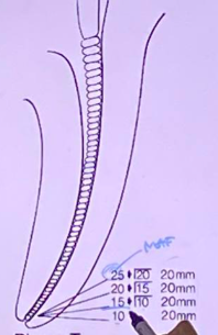 <p>apical preparation up to the file #25 (MAF) to full WL with recapitulation using prior size files</p><p><span>In this example, start with 10 (patency file) → recapitulation Before proceeding to the next, you go back</span></p><ul><li><p>MAF → 25mm</p></li><li><p>IAF → 10mm</p></li></ul><p></p>