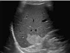<p>The most common benign solid lesions of the liver</p><p>Most measure <3 cm but larger lesions are possible</p>