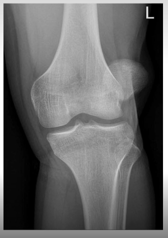 <p>usually <strong>lateral</strong> displacement (bulge) &amp; lack of patella in correct position</p><p>—> splint injury (under a lot of tension so might relocate during splinting)</p>