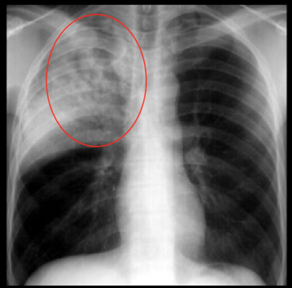 <p>alveoli are filled with pus making the bronchi visible as an air bronchogram. dark lines through area of white.</p>