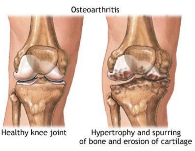 <ul><li><p>Joints</p><ul><li><p>Greatest effect in synovial joints</p></li><li><p><strong>Wearing</strong> down of <strong>articular</strong> <strong>cartilage</strong></p></li><li><p><strong>Matrix</strong> <strong>replacement</strong> <strong>declines</strong> and matrix becomes more rigid</p></li><li><p><strong>Synovial</strong> <strong>fluid</strong> <strong>production</strong> <strong>decreases</strong></p></li><li><p><strong>Ligaments</strong> and <strong>tendons</strong> <strong>around</strong> <strong>joints</strong> <strong>shorten</strong> and become less flexible</p></li><li><p><strong>Arthritis</strong> – inflammatory degeneration of joints</p></li></ul></li></ul><p></p>