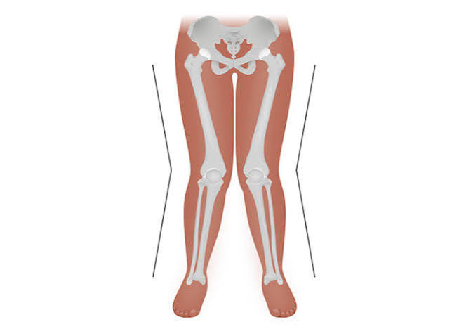 <p>knock-knee, distal segment</p>