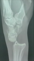 <ul><li><p>Rare</p></li><li><p>Collateral ligaments can be damaged</p></li><li><p>The radiocarpal joint is displaced</p></li><li><p>Anterior or Posterior Displacement</p></li></ul><p></p>