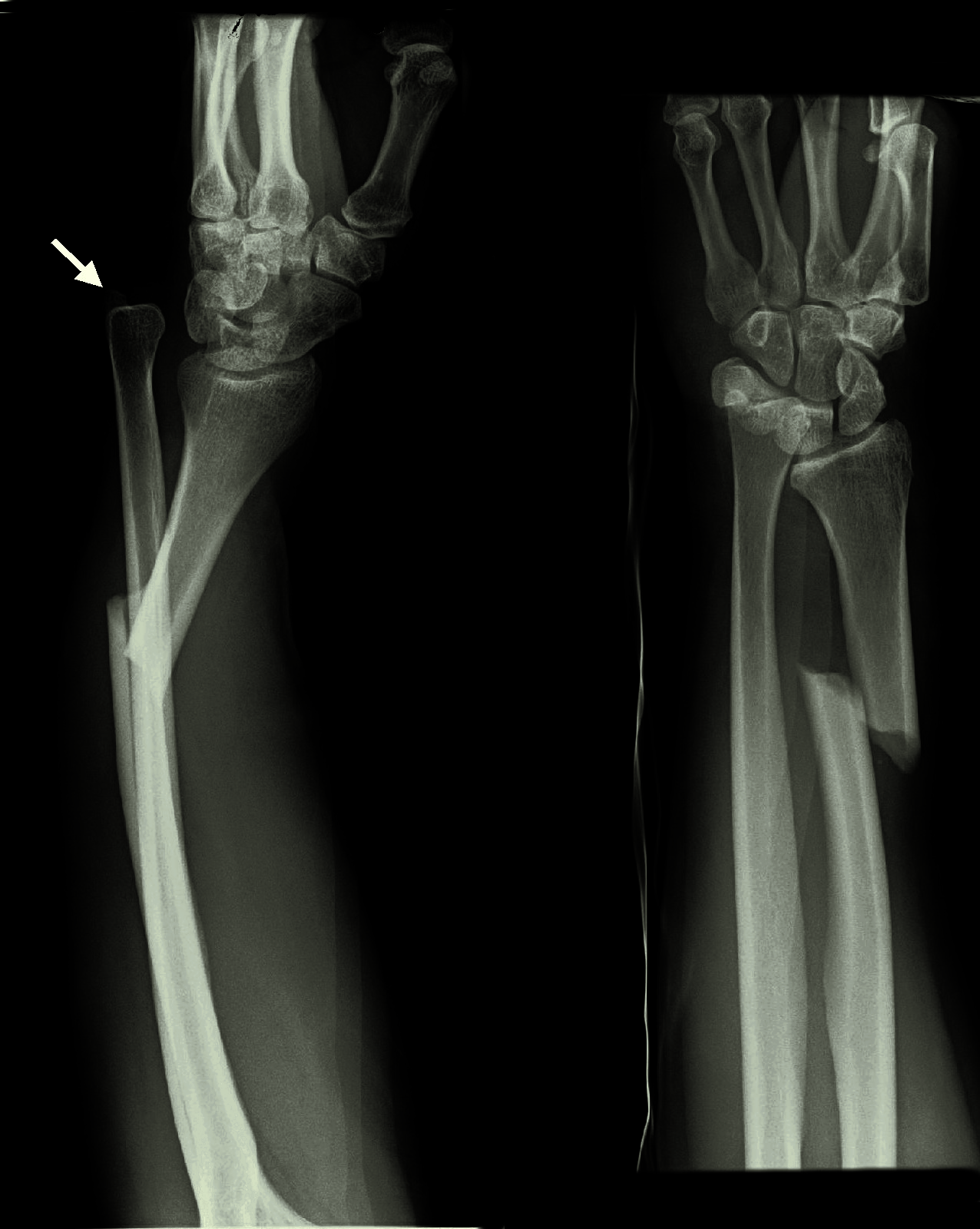 <p>Distal radius + dislocation distal radioulnar joint</p>