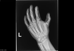 <p>displacement of a bone from its joint</p>