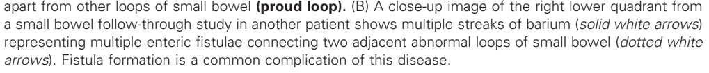 <p>Crohn Disease</p>