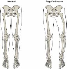 <ul><li><p>overactive osteoclasts cause pores and weakening of long bones = <strong>bending/bowling</strong></p></li><li><p>osteoblasts try to compensate for overactive osteoclasts</p></li><li><p><strong>weak/brittle</strong>, prone to fractures</p></li></ul><p></p>