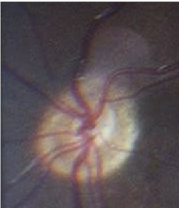 <ul><li><p>Congenital underdevelopment of the optic nerve</p></li><li><p>Incidence ≈ 2 per 100,000 births</p></li><li><p>May be unilateral or bilateral</p></li></ul><p></p>