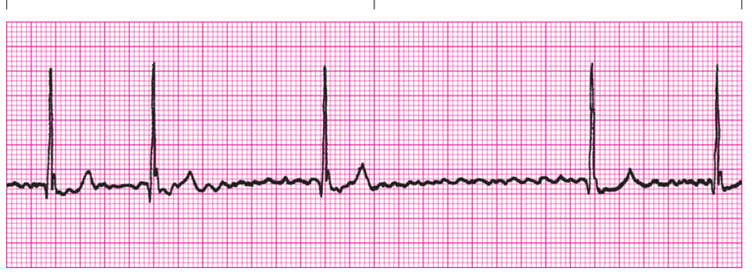<ol><li><p>Regularity?</p></li><li><p>Rate</p></li><li><p>P Waves</p></li><li><p>PRI</p></li><li><p>QRS</p></li><li><p>Interpretation</p></li></ol><p></p>