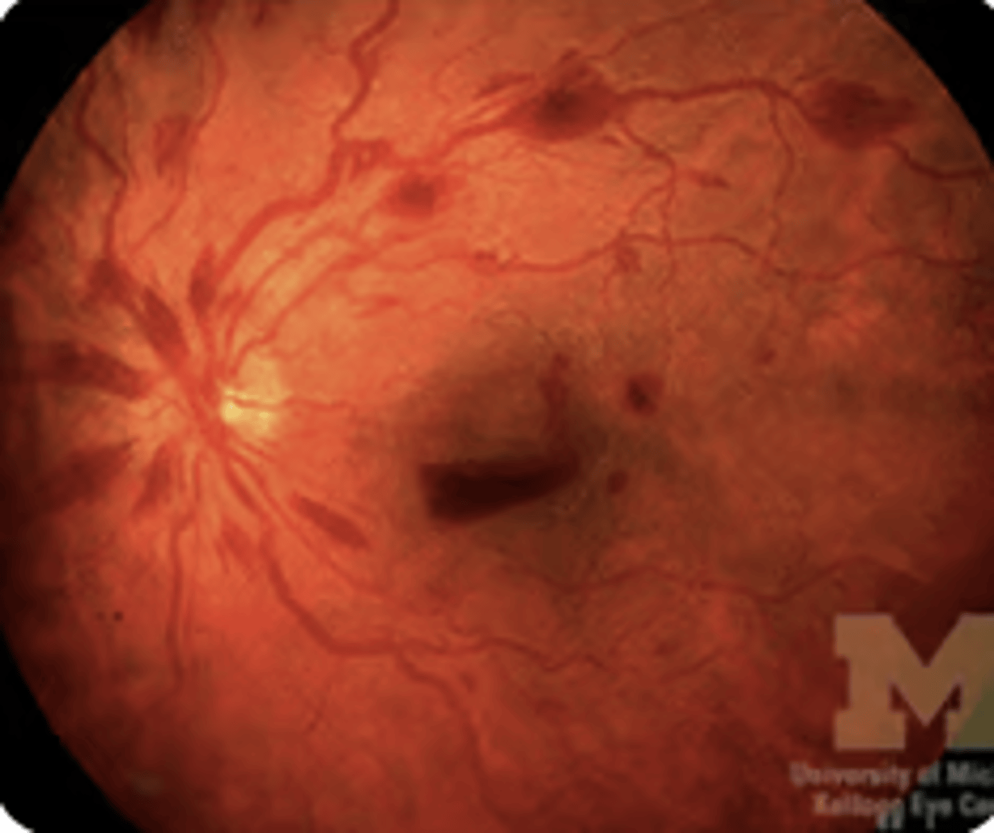 <p>•Bleeding in the retina - can be superficial, preretinal, or deep</p><p>•Seen in sudden increases in intracranial pressure, severe hypertension, and diabetes</p>