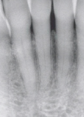 <p>deposition of secondary dentin reduces pulp space</p>