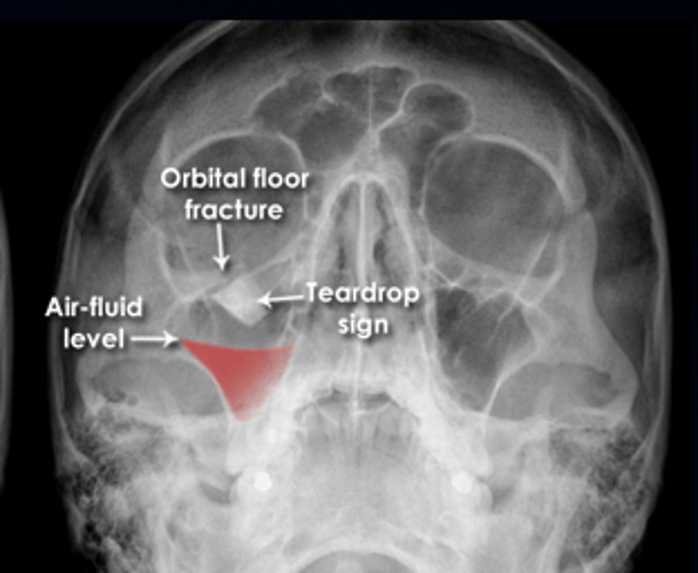<p>A. Blow-out fracture</p>