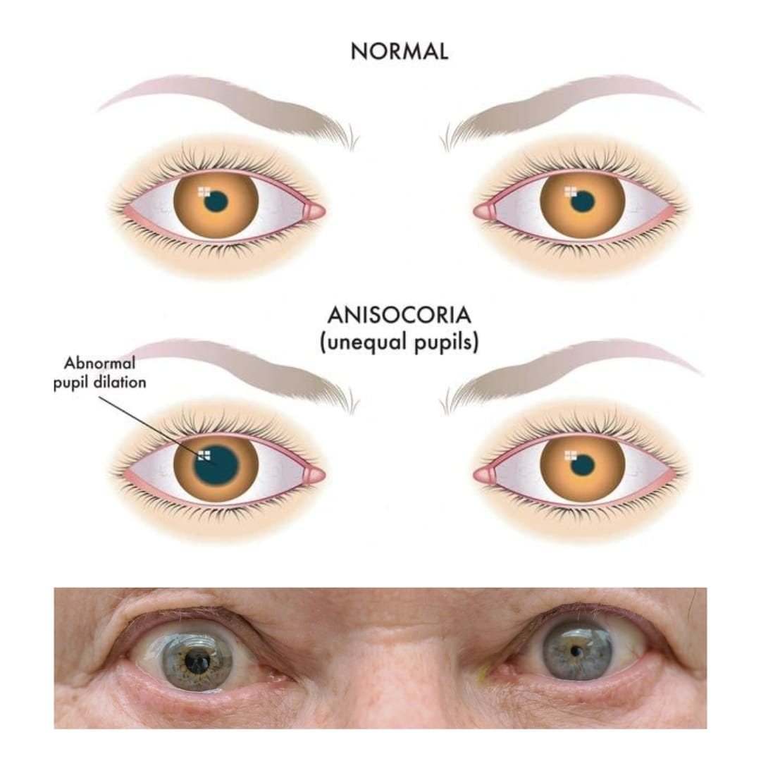 <p>unequal pupils</p>