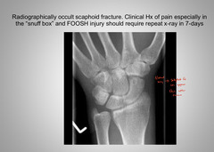<p>Occult fractures</p>