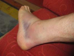 <p>- Edema</p><p>- Erythema</p><p>- Ecchymosis</p><p>- Instability/Crepitus/Deformity</p><p>- Pain/Tenderness</p>