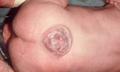 <p>Sometimes vertebral arch doesn't close and this happens - exposure of the nervous system tissue</p><p>How is this prevented? Folic acid taken before and during pregnancy</p>