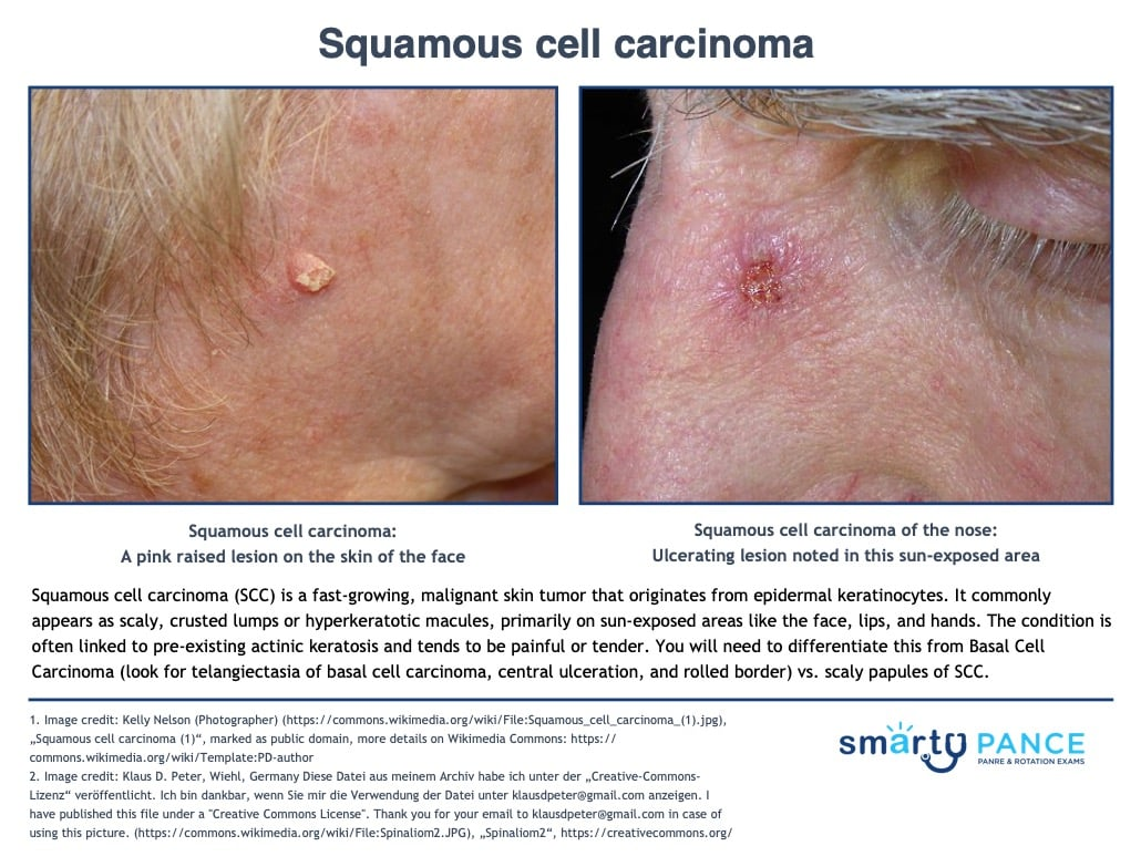 <p>Cancer arising from keratinocytes</p><p>-Presentation: firm, scaly or ulcerated papule/nodule on sun-exposed skin that can arise from actinic keratosis, chronic wounds, scars, and mucosa </p><p>-Dx: shave or punch biopsy </p><p>-Tx: surgical excision with wide margins </p>