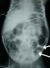 <p>-pneumatosis intestinalis on XR</p>