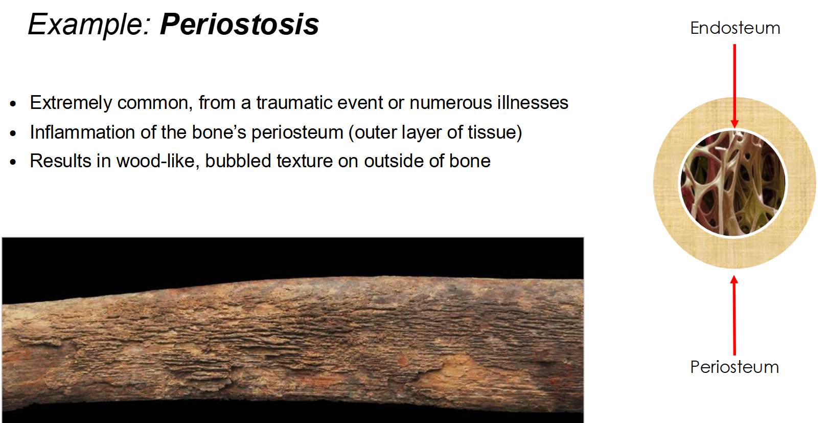 <p>Inflammatory or Infectious Disease Example: Periostosis</p>