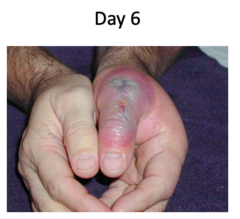 <p>Initially: +/- painful</p><p>1-4 hours later: Painful, red blisters at bite surrounded by pale ring, +/- red halo, Bull's eye lesion, Fever, chills, malaise, nausea</p><p>2-6 hours later: Serve burning pain, Pruritus</p><p>12-16 hours later: Wound site becomes vesiculated, Marked edema</p><p>2-6 days: Necrosis at bite site, Regional, lymphadenopathy , Shock</p>