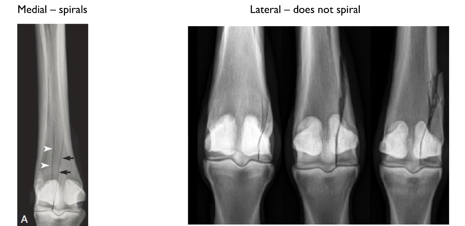 <p>What type of fracture is shown</p>