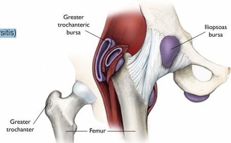<p><span style="color: red;"><strong>Remove source of irritation to bursa</strong></span></p><ul><li><p>Activity Modification</p><ul><li><p><mark data-color="blue" style="background-color: blue; color: inherit;">Avoid lying on affected side (trochanteric bursitis)</mark></p></li><li><p><mark data-color="blue" style="background-color: blue; color: inherit;">Pillow between knees</mark></p></li></ul></li><li><p>Treat relevant impairment (Strengthening, mobility, etc.)</p></li><li><p>Modalities for inflammation</p><ul><li><p>NSAIDS, local injections</p></li></ul></li></ul><p></p>