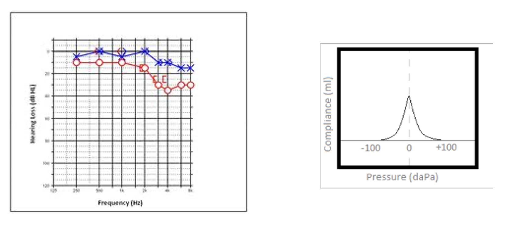 <p><span>Absent acoustic reflexes in right ear</span></p><p><span>Unilateral tinnitus (high-pitched)</span></p><p style="text-align: left;"><span>Difficulty understanding speech in affected ear</span></p><p><span>Some dizziness</span></p>