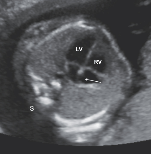 <p>foramen ovale</p>