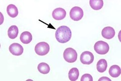 <p>Aggregation of RNA, exposure to lead, accelerated or abnormal hemoglobin synthesis, thalassemia</p>