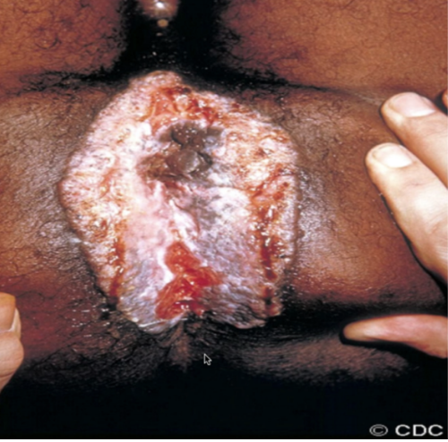 <p>⚠️‼️(#4)72.Identify the lesion: A.Molluscum contagiosum B.Condyloma acuminate C.Lymphogranuloma venereum D.Granuloma inguinale</p>