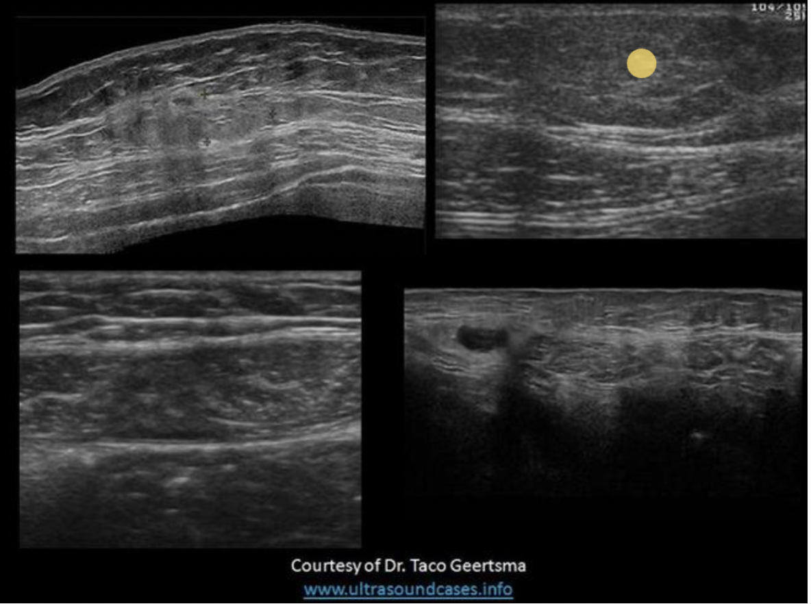 <p>The top two images demonstrate solid masses that are superficial to the rectus abdominis muscle. Top left is a benign mass with lobulated borders and the top right is a lipoma. Both are located in the subcutaneous tissues/fat. The lipoma has smooth borders and an echogenicity similar to the surrounding fat. </p><p>The bottom right image demonstrates a spigelian hernia, between the right rectus abdominis and right oblique muscles. </p><p>The bottom left image demonstrates a hematoma in the rectus abdominis muscle, between the anterior and posterior rectus sheaths.</p>
