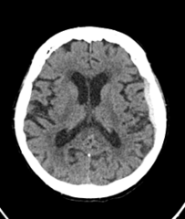 <p>blood under the dura but not intracranial (convex)</p><p>traumatic injury to bridging veins</p><p>acute versus chronic presentations</p>