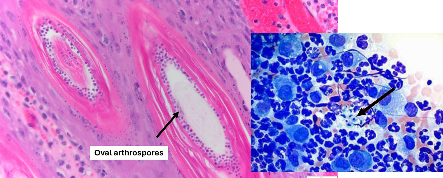 <ul><li><p><strong>breaks</strong> in stratum corneum facilitate invasion by the fungus → adhere to keratinocytes &amp; migrate to follicular orifice</p></li><li><p>dermatophytes produce <strong>keratinolytic enzymes</strong> that hydrolyze keratin and enable them to <strong>invade the hair shaft</strong> → invade to the keratogenous zone of the hair bulb</p><ul><li><p>stop here as <strong>cannot survive in viable tissues</strong></p></li></ul></li><li><p>as hair enters telogen, hair is sloughed and fungal growth stops</p></li></ul><p>overall, self-limiting disease</p>
