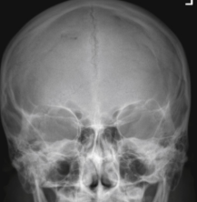 <p>PA skull</p>