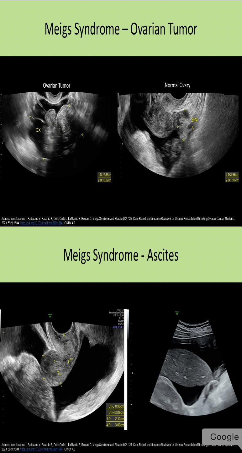<p>C. ascites and pleural effusion</p><p>Meigs syndrome = pelvic ascites and pleural effusion with benign ovarian tumor, most commonly a fibroma</p>