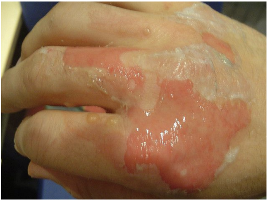 <p>A 4-year-old child presents to the ED with burns on his left arm after exposure to scalding water. The affected area is erythematous, weeping and blistered in several places (see attached image). The area is extremely sensitive to the touch. It blanches easily with pressure. What is the most likely classification of the depth of this injury?</p>