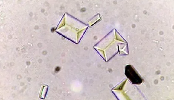 <p>These crystals are found in what kind of urine? Are they pathogenic?</p>