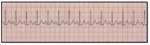 <p>Identify:<br>a. normal sinus rhythm<br>b. sinus arrhythmia<br>c. atrial fibrillation <br>d. sinus tachycadia </p>
