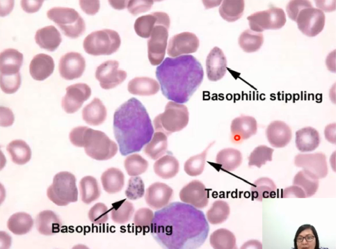 <p>- Basophilic Stippling, ALA and</p><p>Porphyrin in the urine</p>
