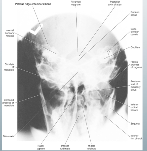 <p>-used to investigate mandibular condyles</p><p>-always ask t to open the mouth because a closed mouth would not be useful for condylar assessment (would get occiput and/or skull base view)</p>