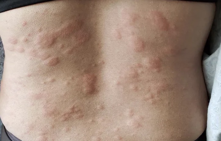 <ul><li><p>Lesions run together</p></li><li><p>Individual lesions that pop up in same general area</p></li><li><p>ex: hives</p></li></ul><p></p>