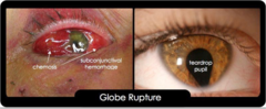 <p>- decreased visual acuity</p><p>- pupillary defect</p><p>- teardrop pupil</p><p>- extrusion of vitreous fluid</p><p>- gross deformity of eye</p>