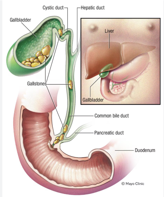 <p><span>Gallstones, which are hardened deposits that form in the gallbladder or bile ducts</span></p>