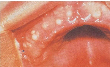 <p>The mother of a 1 month old baby has a concern of white nodules in the mouth of her kid. The clinical image is shown below. There is no pain or any other symptoms. Provide diagnosis</p>